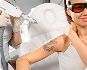 Удаление татуажа